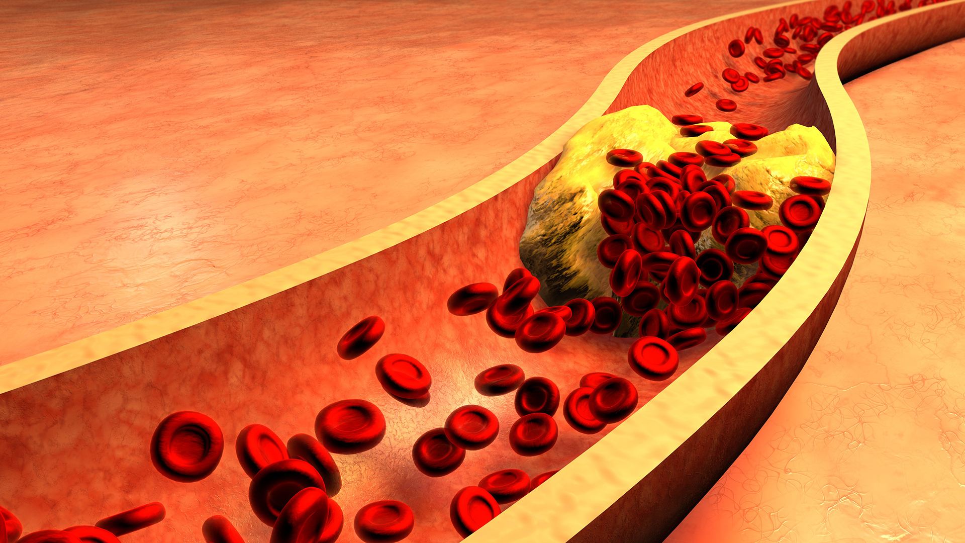 Verstopfte Arterie mit Blutplättchen und Cholesterin-Plaque dargestellt in einer Grafik.